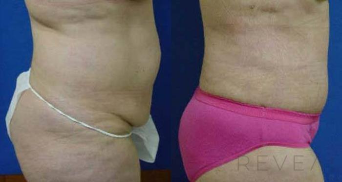Before & After Tummy Tuck Case 53 View #3 View in San Jose, CA