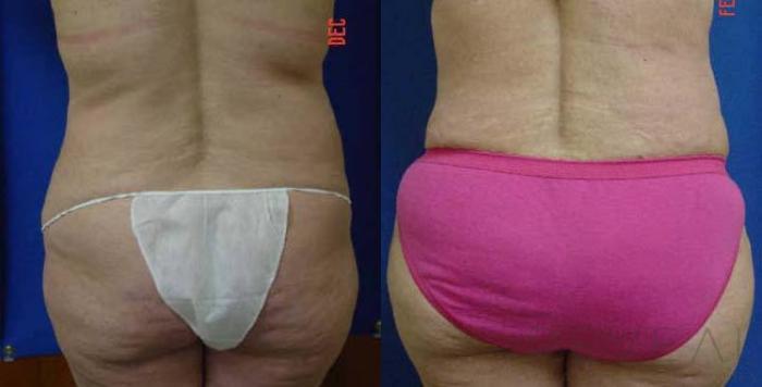 Before & After Liposuction Case 53 View #4 View in San Jose, CA