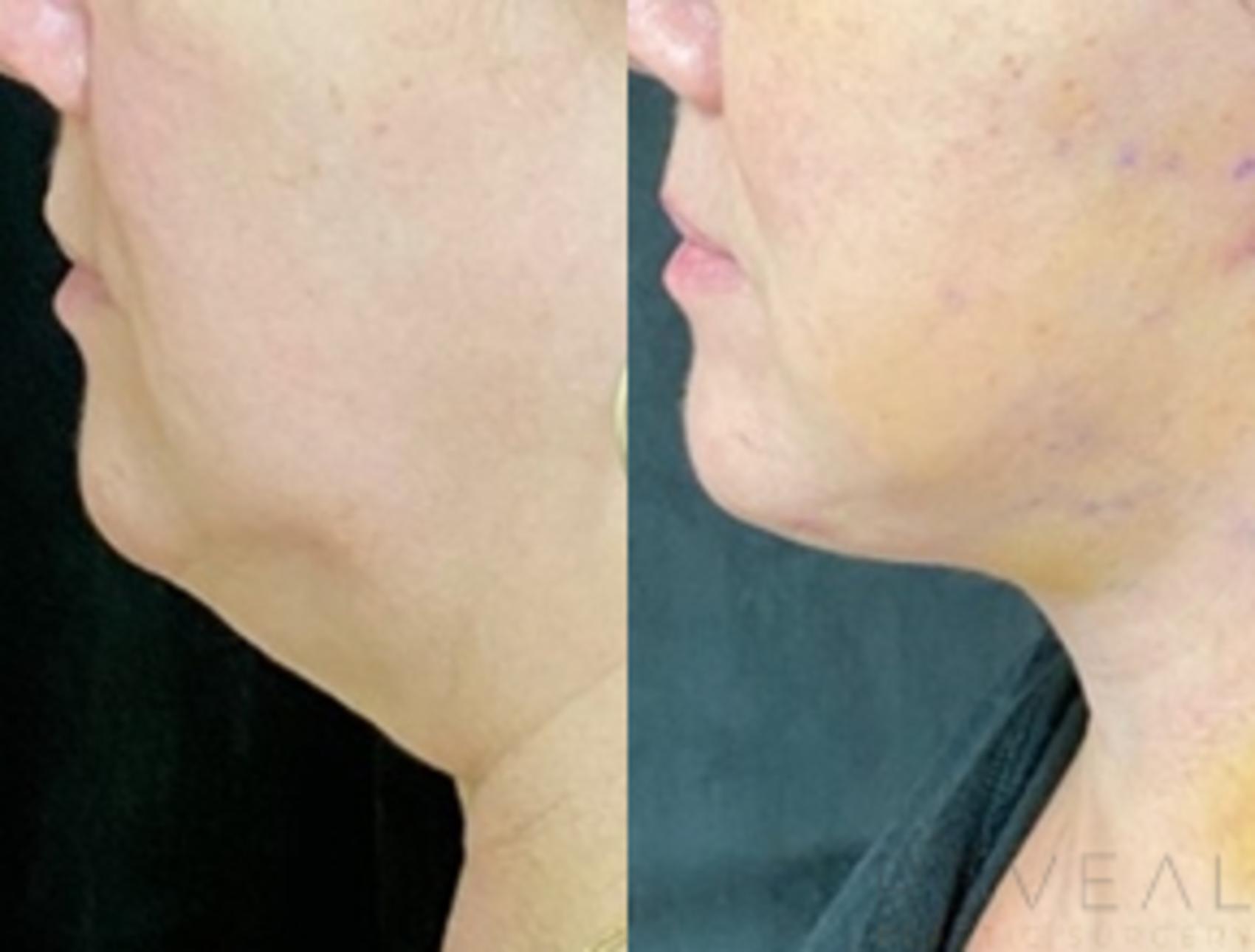 Before & After Liposuction Case 546 View #1 View in San Jose, CA