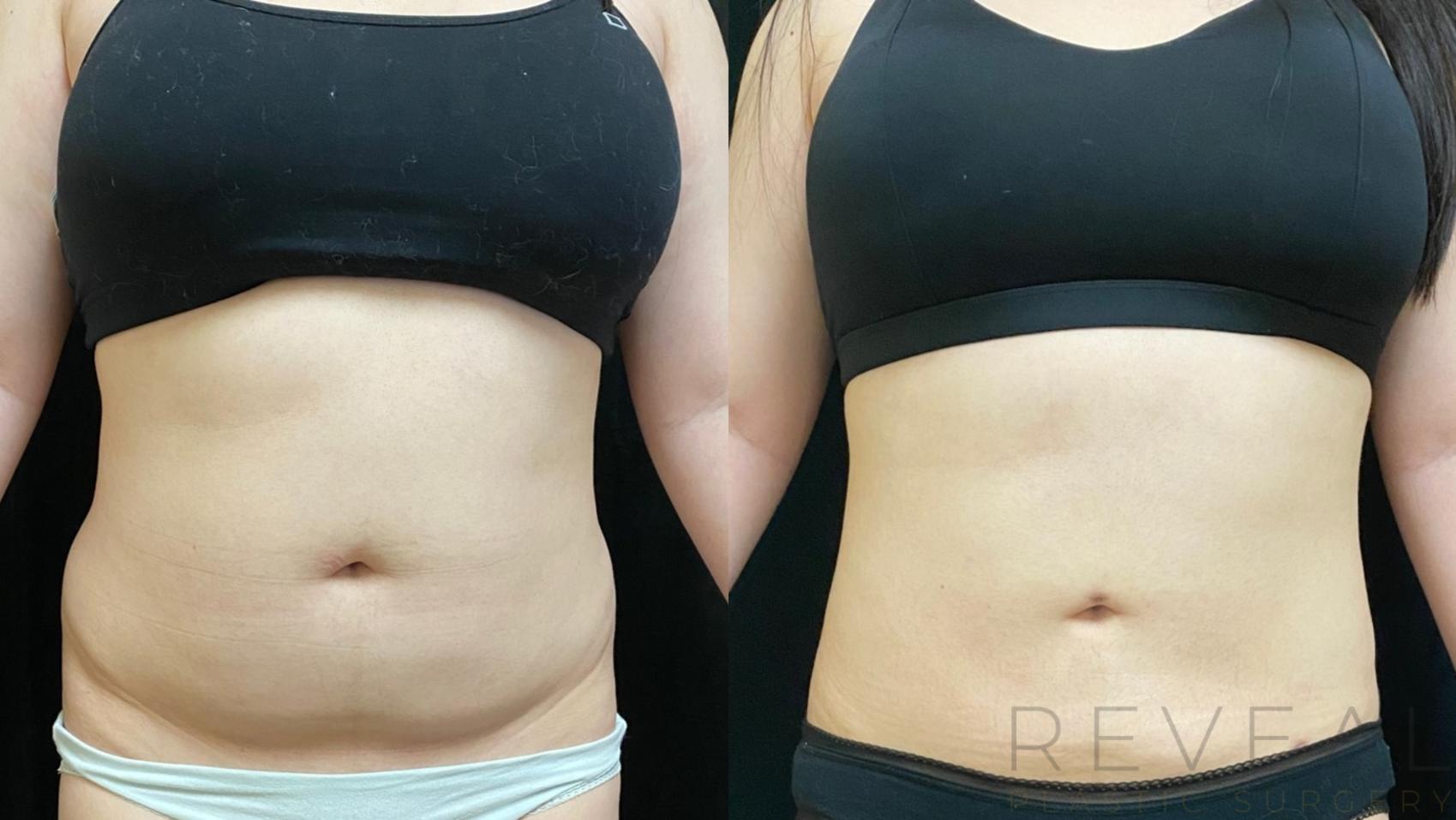 Before & After Liposuction Case 554 View #1 View in San Jose, CA