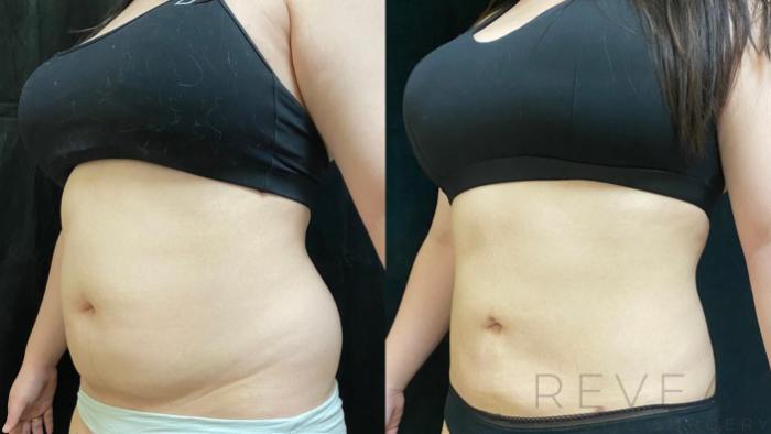 Before & After Liposuction Case 554 View #2 View in San Jose, CA
