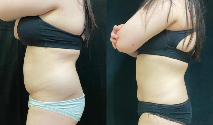 Before & After Liposuction Case 554 View #3 View in San Jose, CA