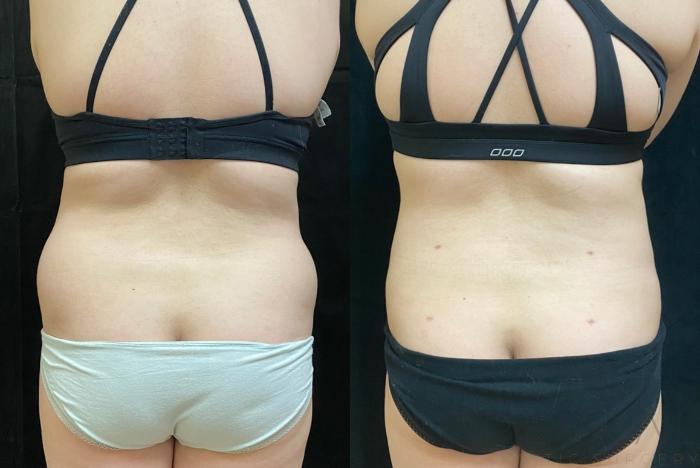 Before & After Liposuction Case 554 View #4 View in San Jose, CA