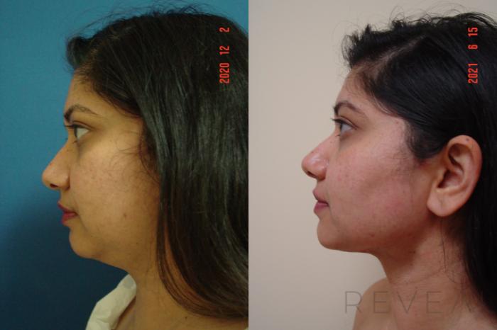 Before & After Liposuction Case 568 View #1 View in San Jose, CA