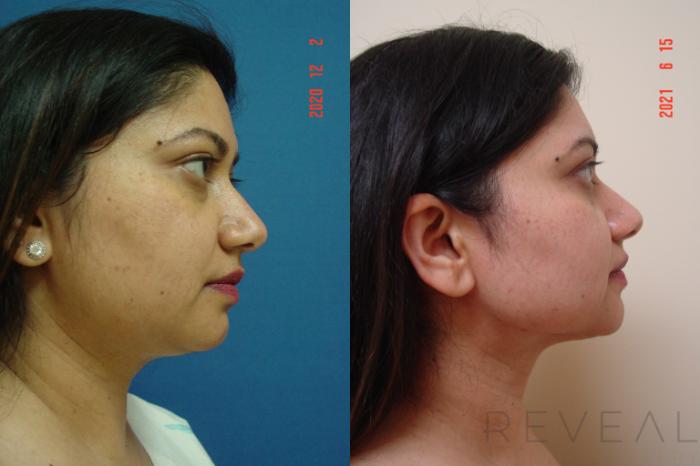 Before & After Liposuction Case 568 View #2 View in San Jose, CA