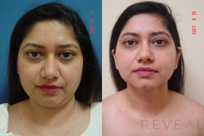 Before & After Liposuction Case 568 View #3 View in San Jose, CA