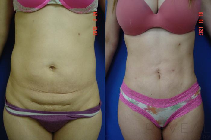 Before & After Liposuction Case 597 Front View in San Jose, CA