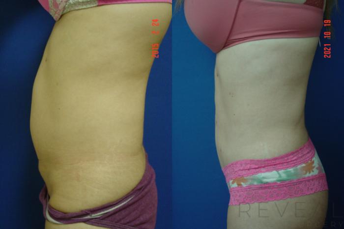 Before & After Liposuction Case 597 Left Oblique View in San Jose, CA