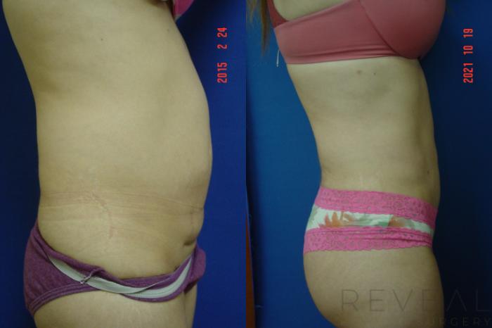 Before & After Liposuction Case 597 Right Side View in San Jose, CA