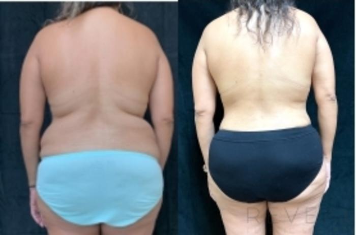 Before & After Liposuction Case 608 Back View in San Jose, CA