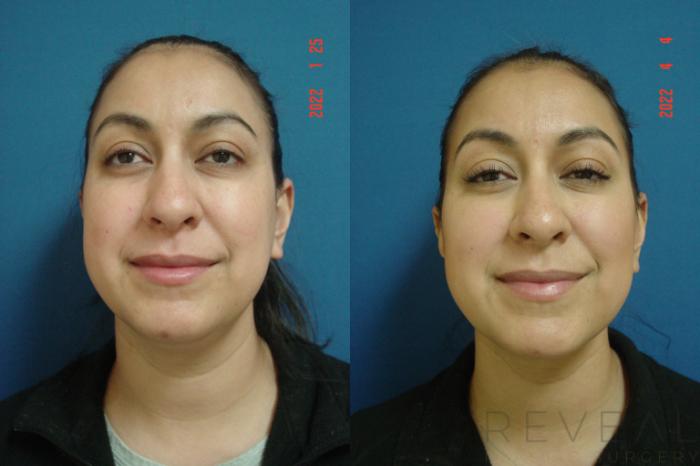 Before & After Liposuction Case 631 Front View in San Jose, CA