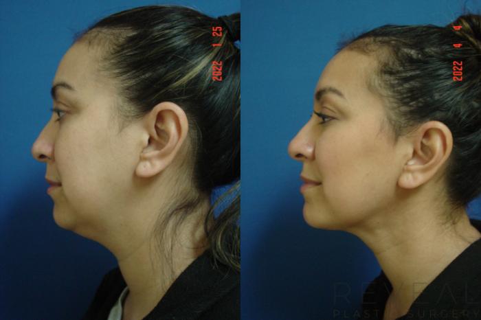 Before & After Liposuction Case 631 Left Side View in San Jose, CA
