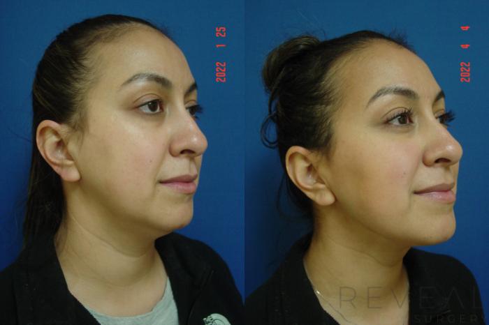 Before & After Liposuction Case 631 Right Oblique View in San Jose, CA
