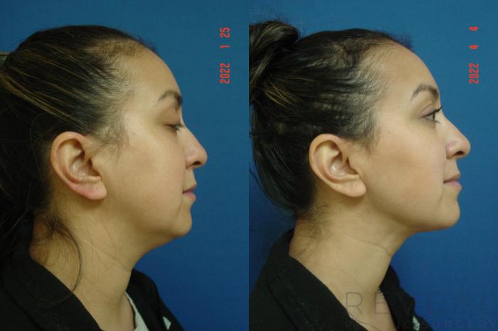 Before & After Liposuction Case 631 Right Side View in San Jose, CA