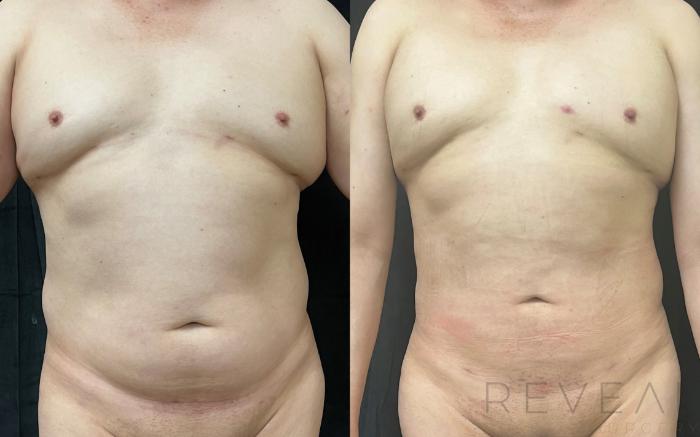 Before & After Liposuction Case 639 Front View in San Jose, CA