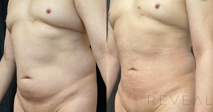 Before & After Liposuction Case 639 Left Oblique View in San Jose, CA