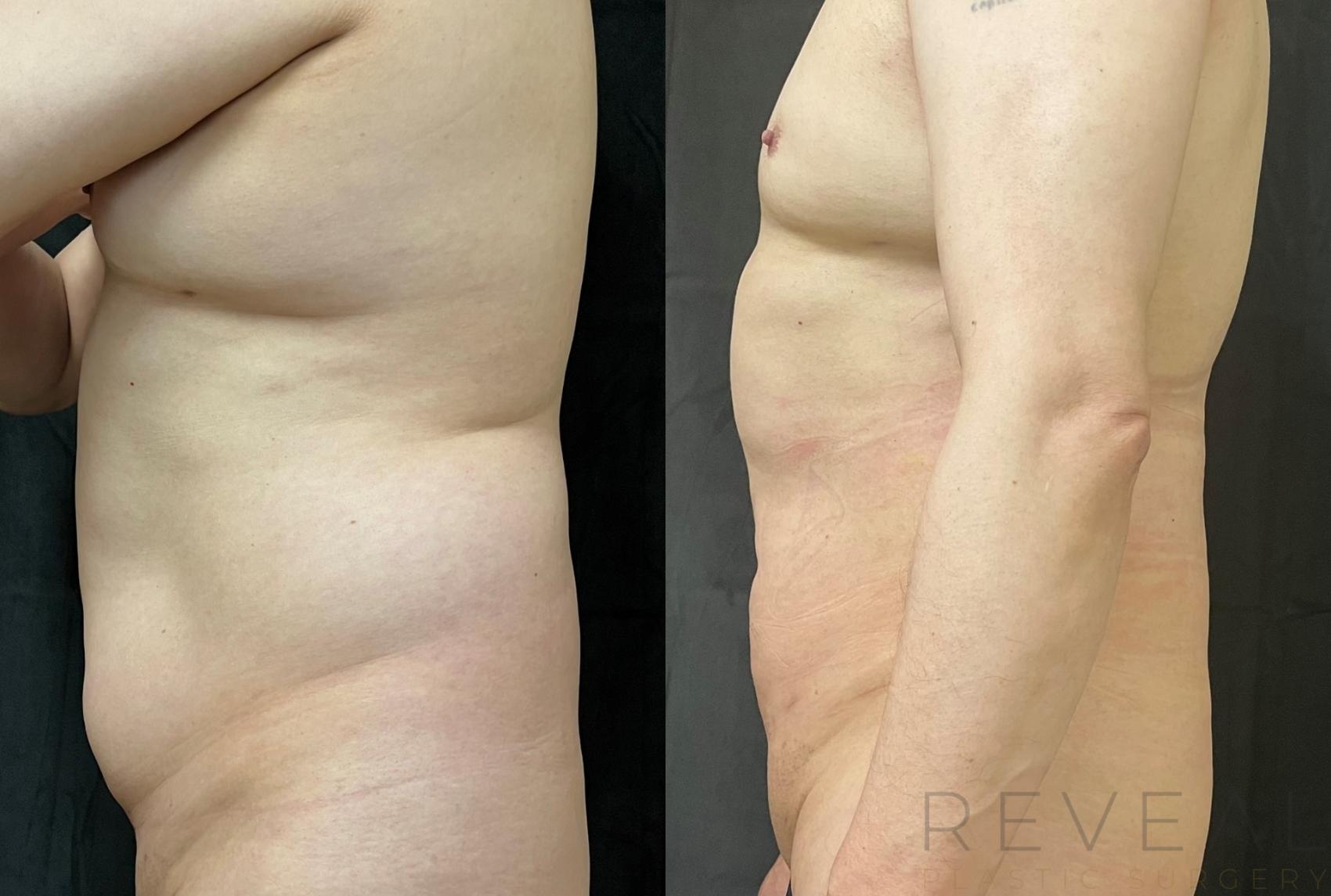 Before & After Liposuction Case 639 Left Side View in San Jose, CA