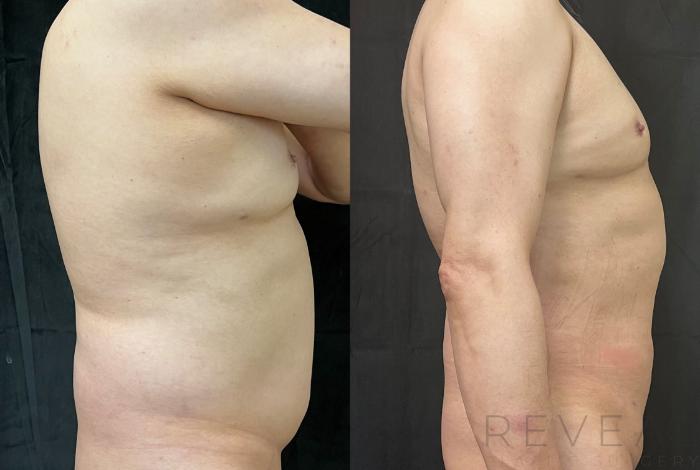 Before & After Liposuction Case 639 Right Oblique View in San Jose, CA
