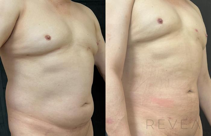 Before & After Liposuction Case 639 Right Side View in San Jose, CA