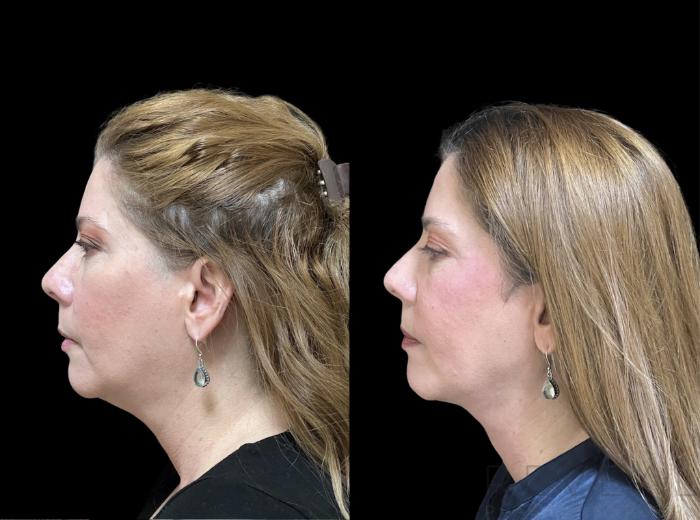 Before & After Neck Lift Case 643 Right Side View in San Jose, CA