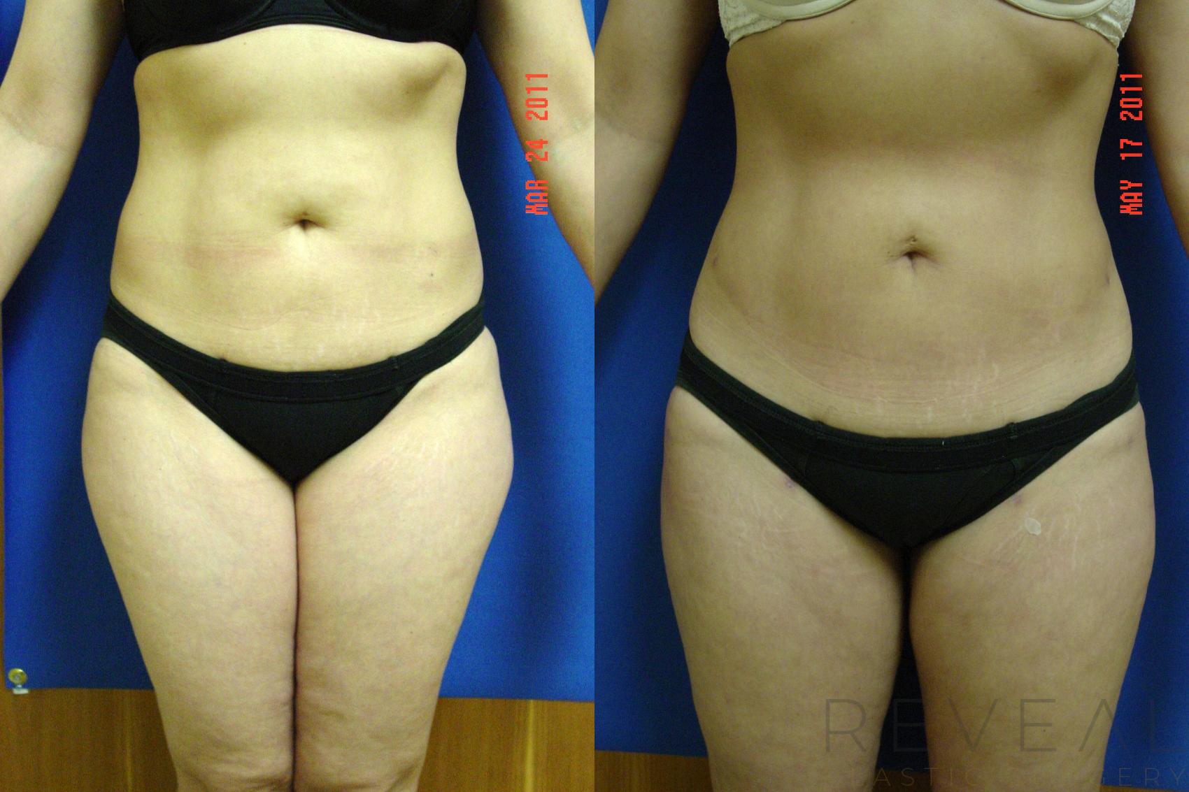 Before & After Liposuction Case 67 View #1 View in San Jose, CA