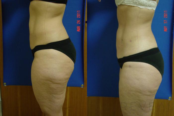 Before & After Liposuction Case 67 View #2 View in San Jose, CA