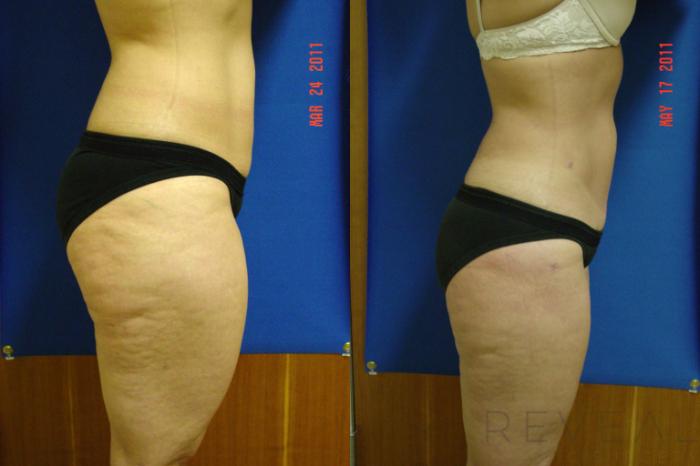 Before & After Liposuction Case 67 View #3 View in San Jose, CA