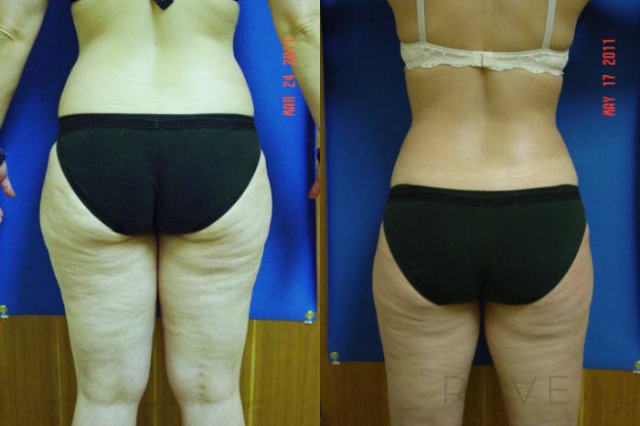 Before & After Liposuction Case 67 View #4 View in San Jose, CA