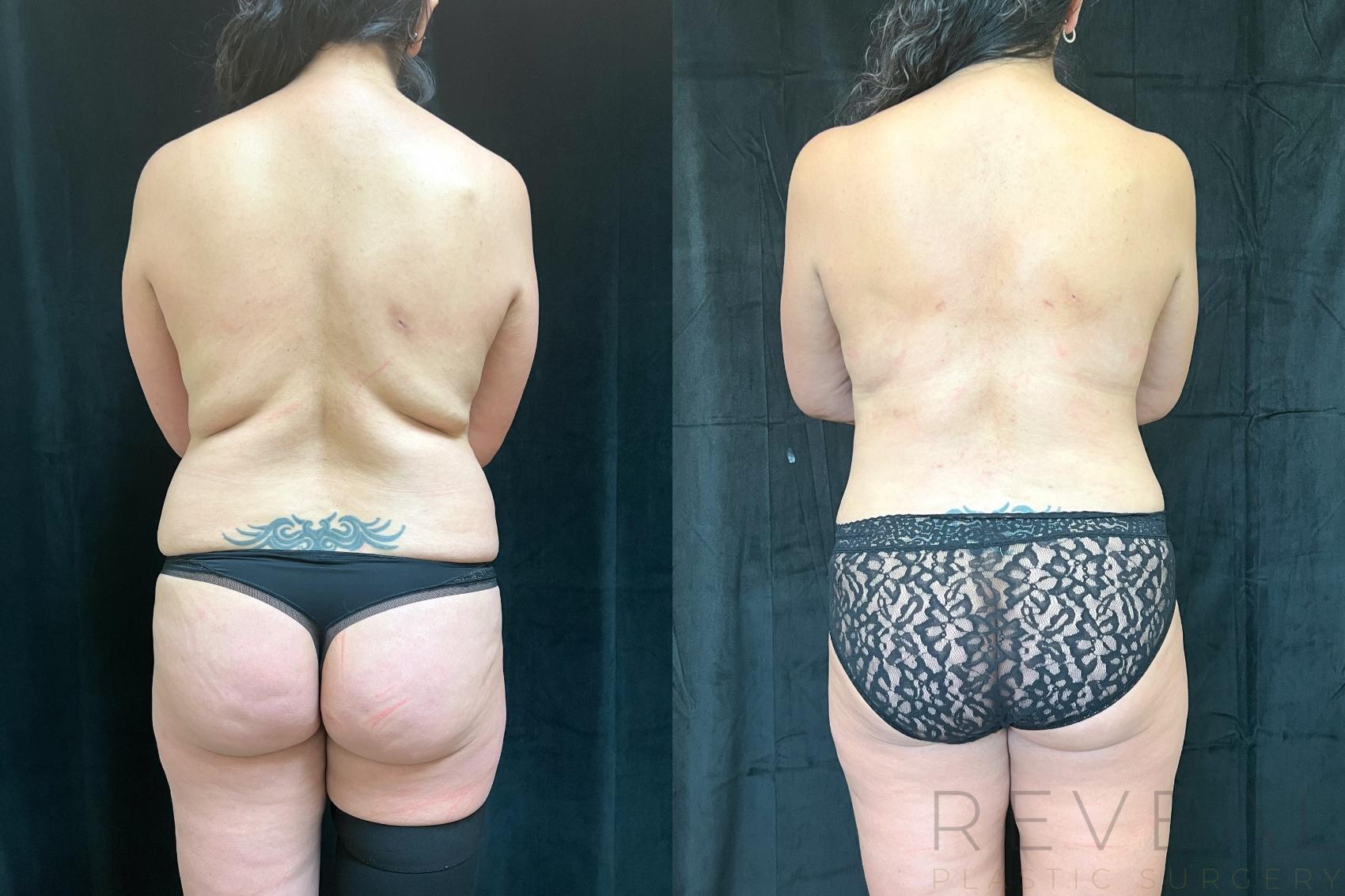 Before & After Liposuction Case 687 Back View in San Jose, CA