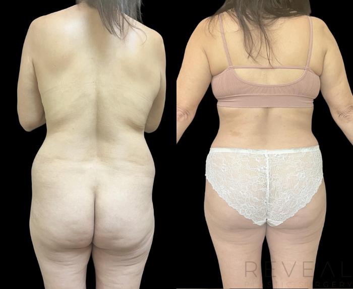 Before & After Brazilian Butt Lift Case 709 Back View in San Jose, CA