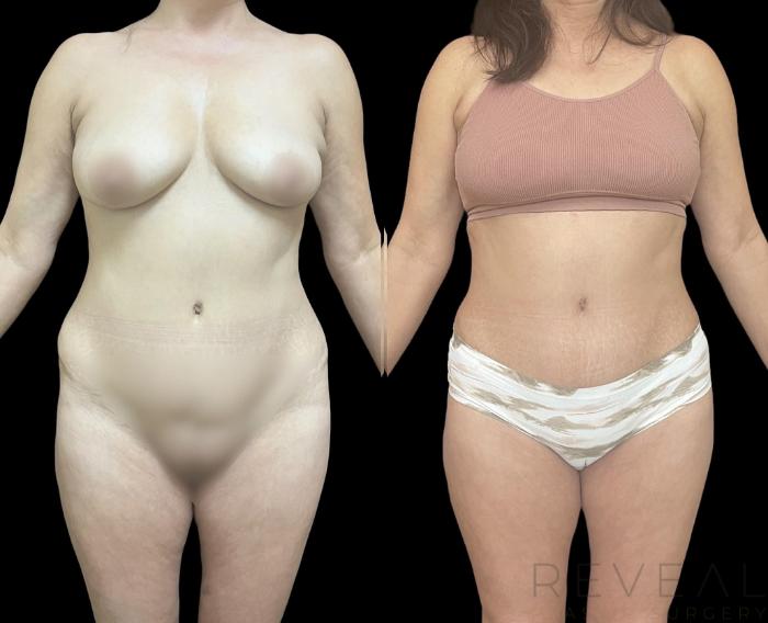 Before & After Liposuction Case 709 Left Oblique View in San Jose, CA