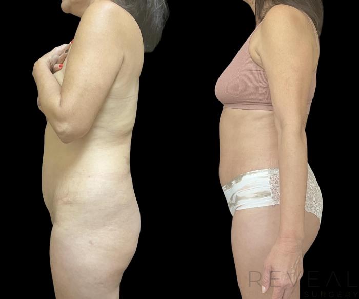 Before & After Liposuction Case 709 Right Side View in San Jose, CA