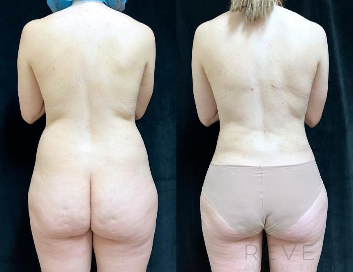 Before & After Liposuction Case 725 Back View in San Jose, CA
