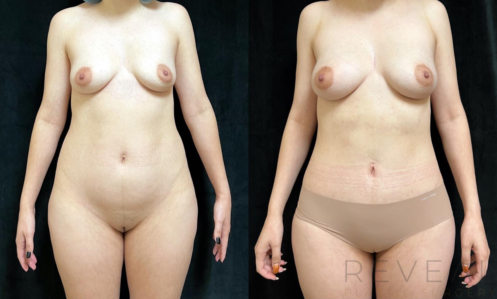 Before & After Liposuction Case 725 Front View in San Jose, CA