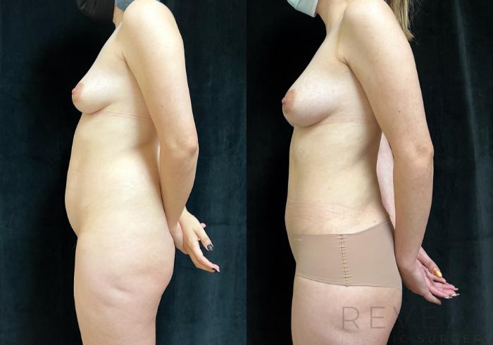 Before & After Liposuction Case 725 Left Oblique View in San Jose, CA