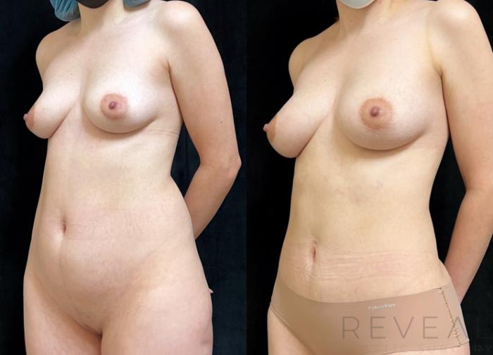 Before & After Mommy Makeover Case 725 Left Side View in San Jose, CA