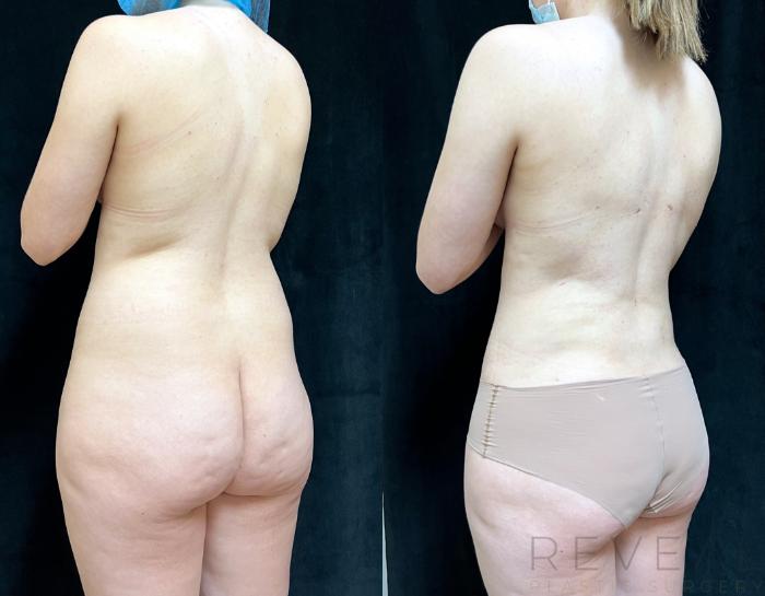 Before & After Liposuction Case 725 Right Oblique View in San Jose, CA
