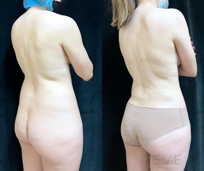 Before & After Liposuction Case 725 Right Side View in San Jose, CA