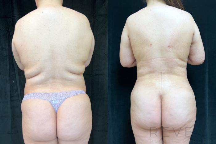 Before & After Liposuction Case 749 Back View in San Jose, CA