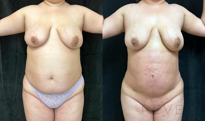 Before & After Liposuction Case 749 Front of the body  View in San Jose, CA