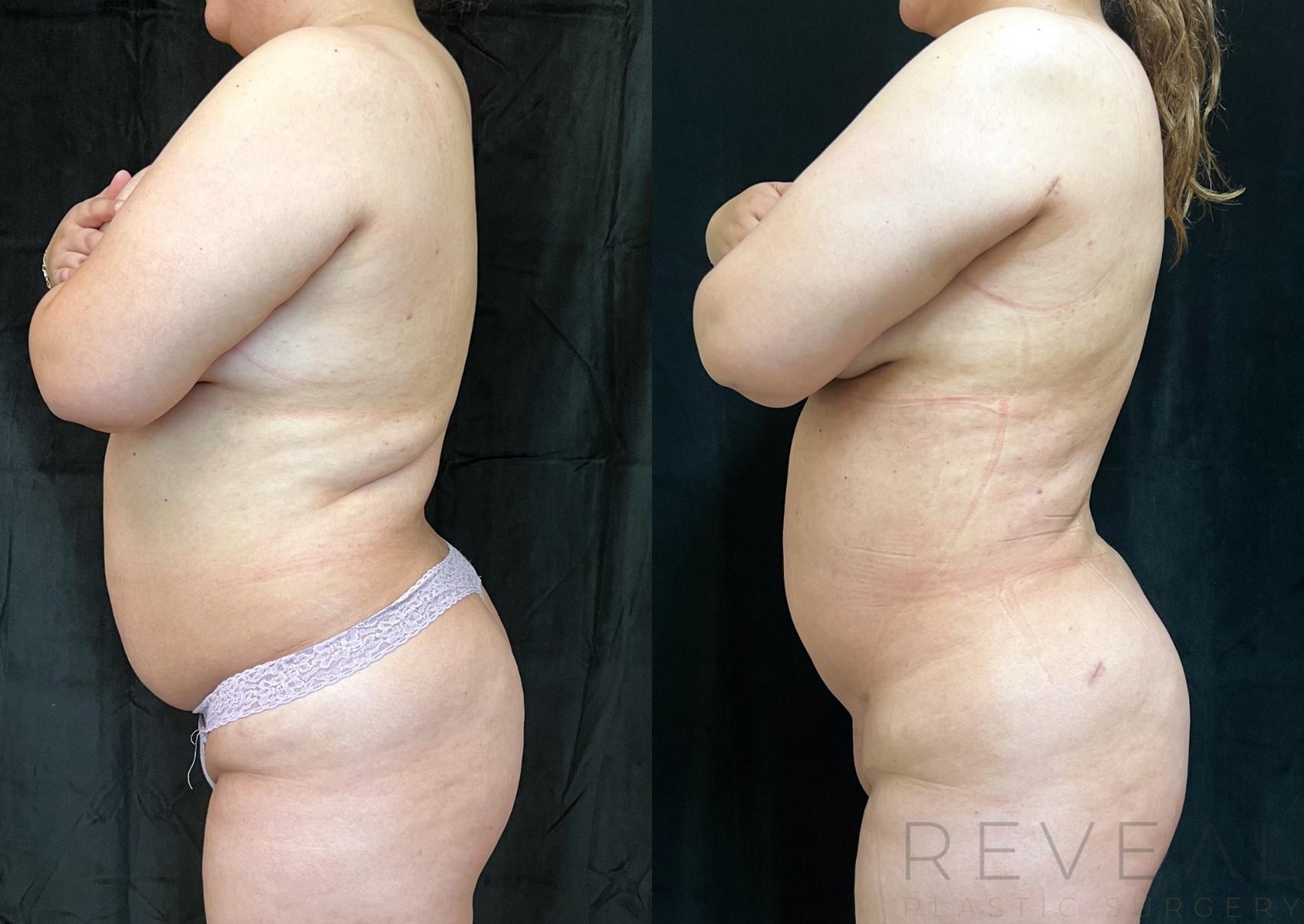 Before & After Liposuction Case 749 Left Oblique View in San Jose, CA