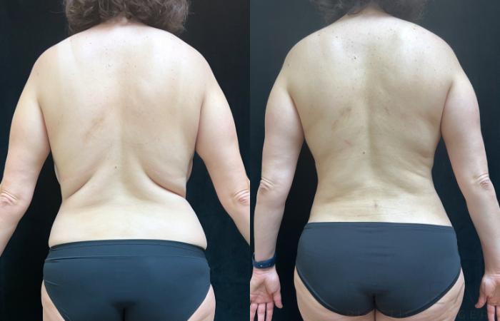 Before & After Liposuction Case 751 Back View in San Jose, CA
