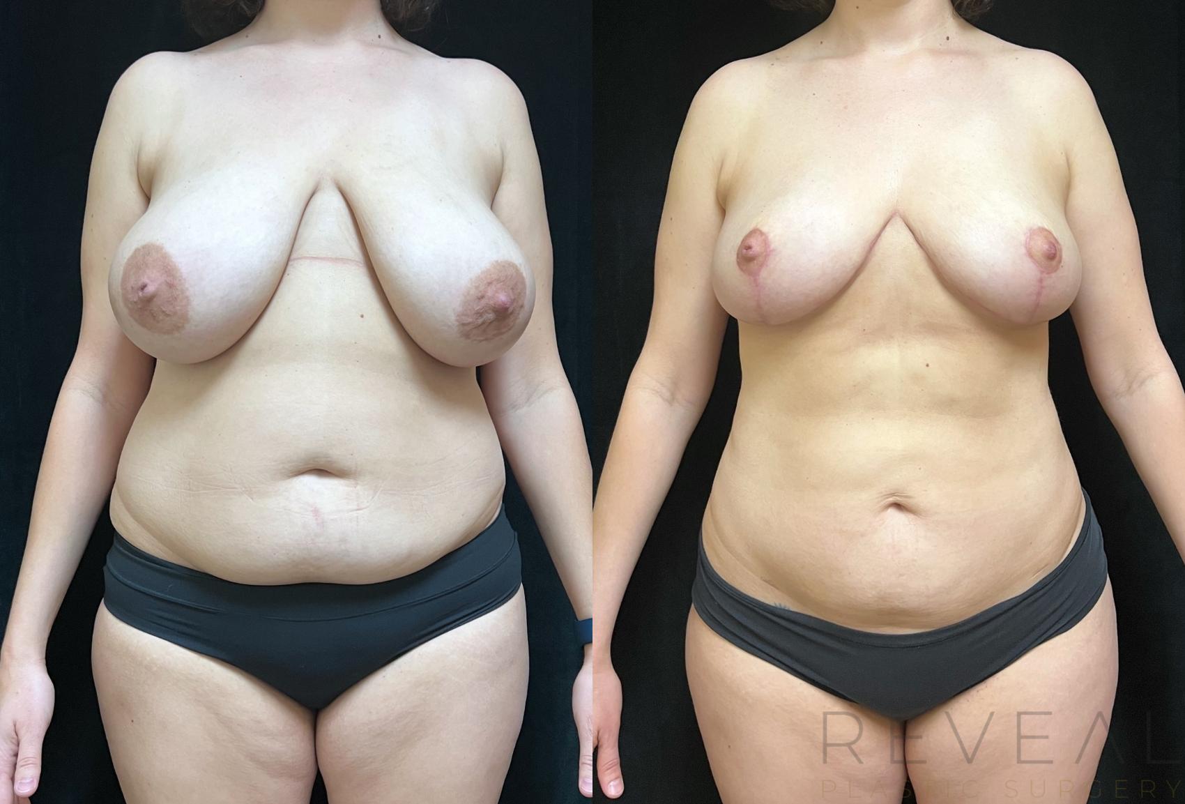 Before & After Liposuction Case 751 Front View in San Jose, CA