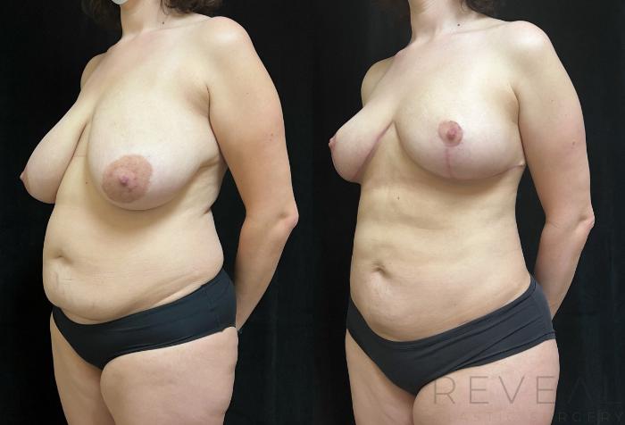 Before & After Liposuction Case 751 Left Side View in San Jose, CA