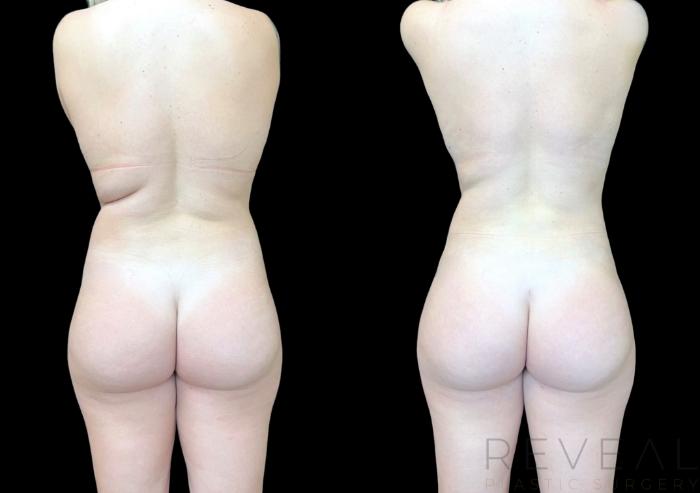 Before & After Liposuction Case 752 Back View in San Jose, CA