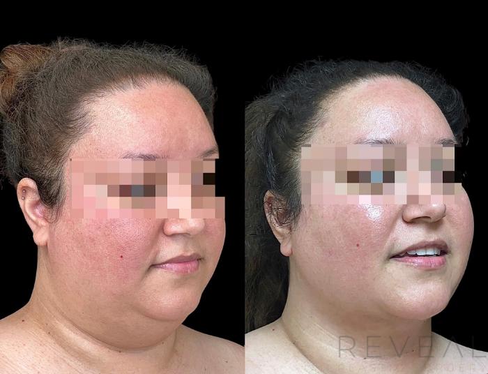 Before & After Liposuction Case 753 Right Oblique View in San Jose, CA
