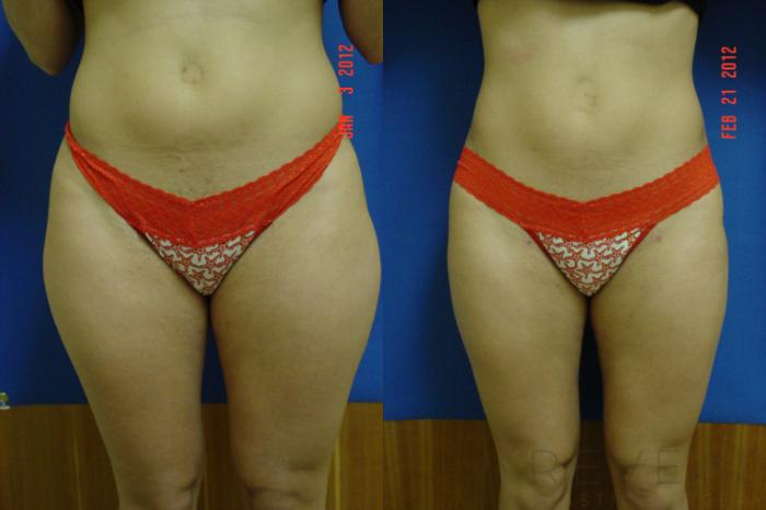 Before & After Liposuction Case 86 View #1 View in San Jose, CA