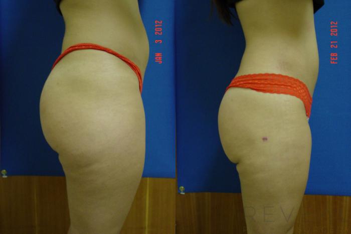 Before & After Liposuction Case 86 View #2 View in San Jose, CA