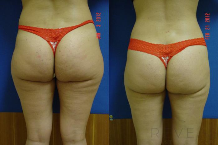 Before & After Liposuction Case 86 View #3 View in San Jose, CA