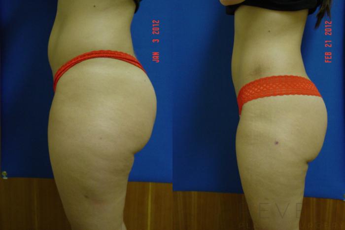 Before & After Liposuction Case 86 View #4 View in San Jose, CA